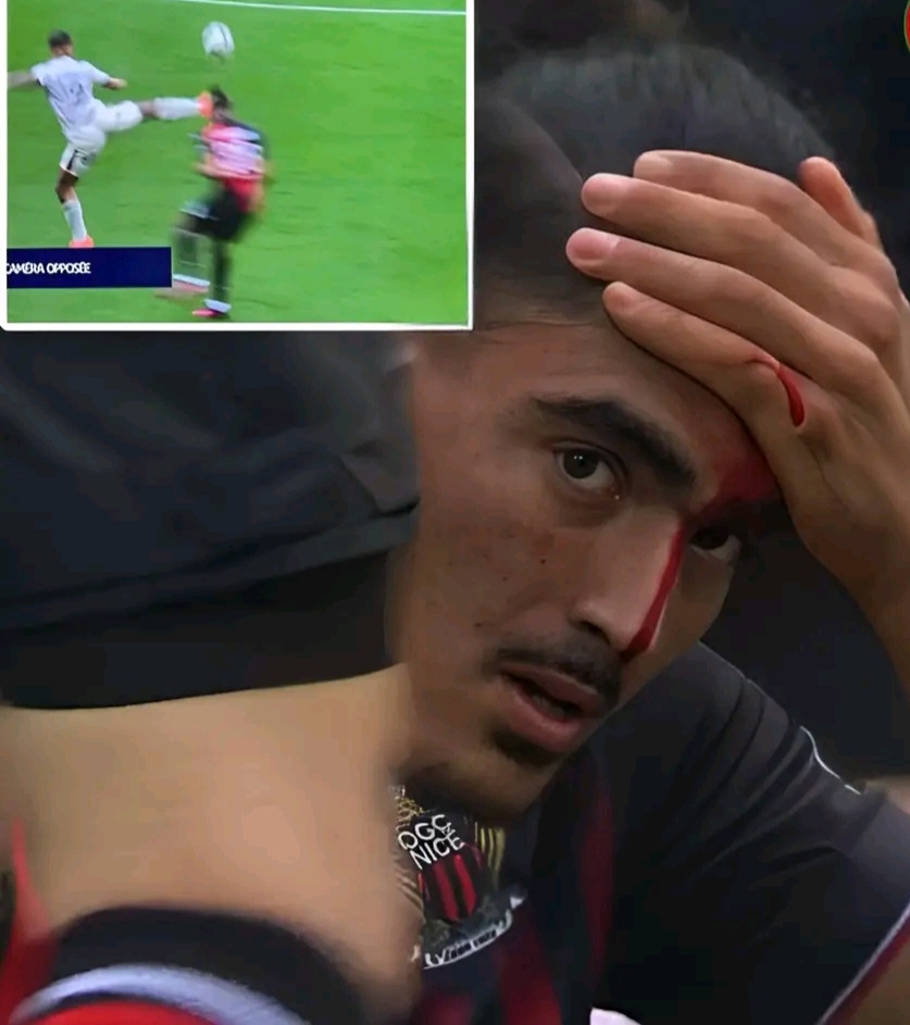 إصابة الدولي المغربي الجديد على المنتخب الوطني المغربي أيوب عمراوي مع ناديه نيس الفرنسي على مستوى الرأس